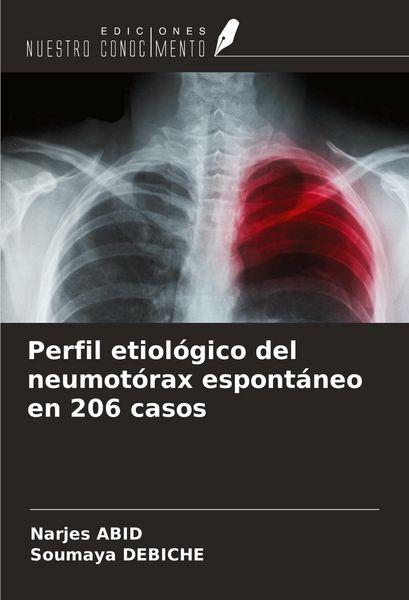 Produktbild: Perfil etiol&oacute;gico del neumot&oacute;rax espont&aacute;neo en 206 casos