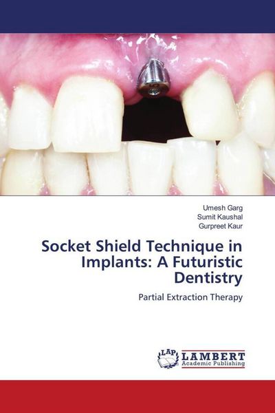 Produktbild: Socket Shield Technique in Implants: A Futuristic Dentistry