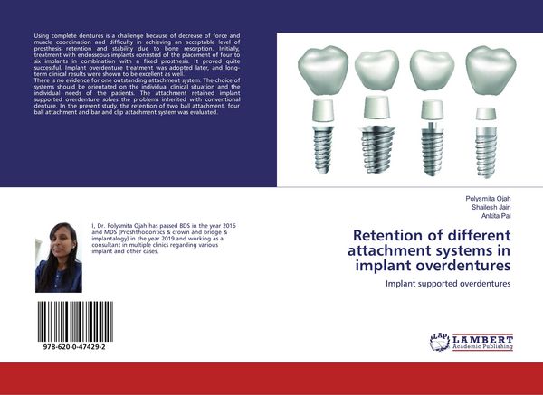 Produktbild: Retention of different attachment systems in implant overdentures