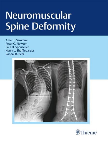 Produktbild: Neuromuscular Spine Deformity