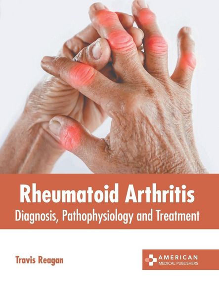 Produktbild: Rheumatoid Arthritis: Diagnosis, Pathophysiology and Treatment