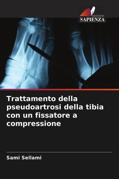 Produktbild: Trattamento della pseudoartrosi della tibia con un fissatore a compressione