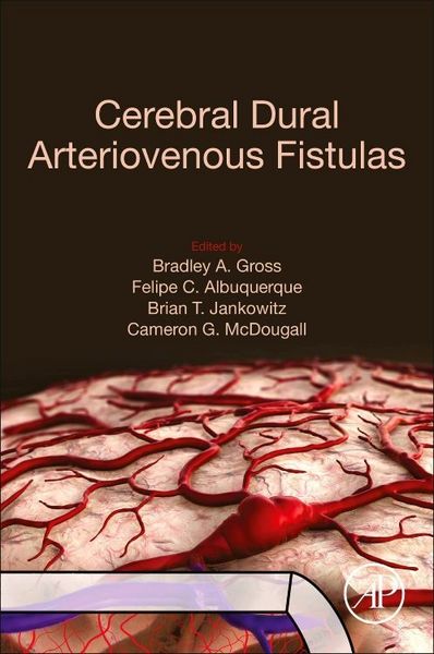 Produktbild: Cerebral Dural Arteriovenous Fistulas