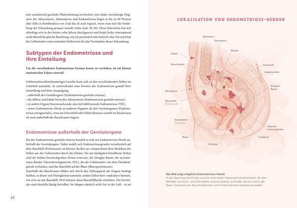 Produktbild: Endometriose &ndash; Die untersch&auml;tzte Krankheit