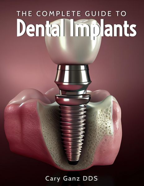 Produktbild: The Complete Guide to Dental Implants (All About Dentistry)