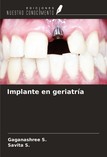 Produktbild: Implante en geriatr&iacute;a