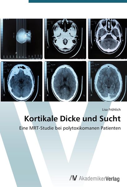 Produktbild: Kortikale Dicke und Sucht