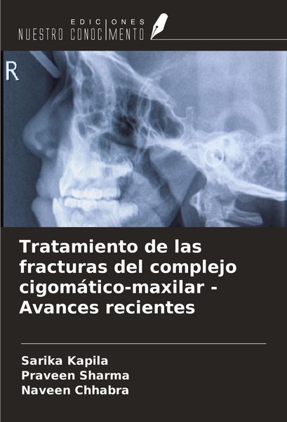Produktbild: Tratamiento de las fracturas del complejo cigom&aacute;tico-maxilar - Avances recientes
