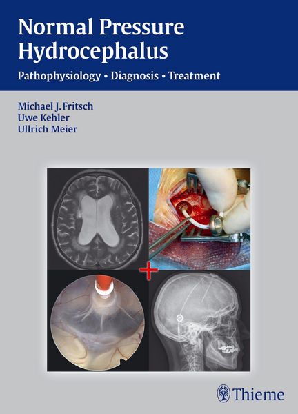 Produktbild: Normal Pressure Hydrocephalus