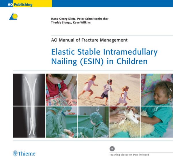 Produktbild: Elastic Stable Intramedullary Nailing (ESIN) in Children
