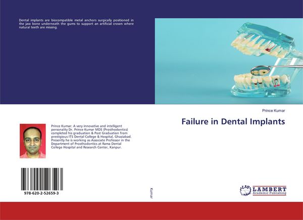 Produktbild: Failure in Dental Implants
