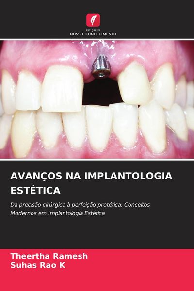Produktbild: AVAN&Ccedil;OS NA IMPLANTOLOGIA EST&Eacute;TICA