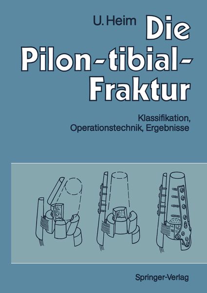 Produktbild: Die Pilon-tibial-Fraktur