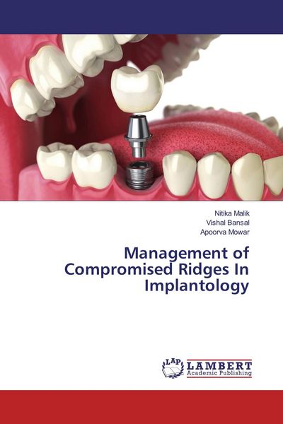 Produktbild: Management of Compromised Ridges In Implantology