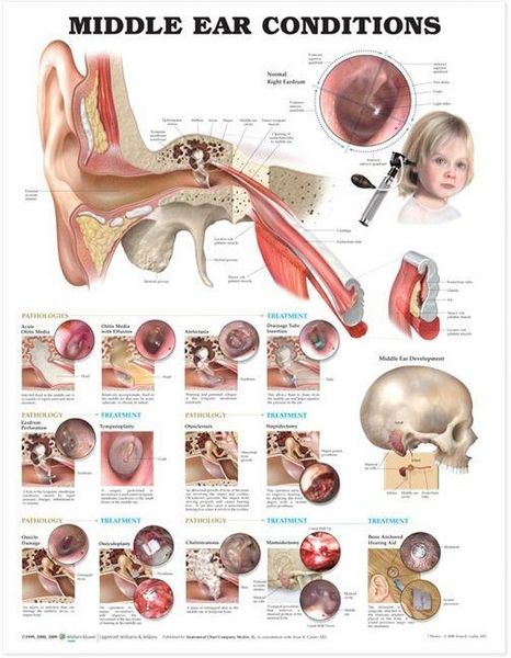Produktbild: Middle Ear Conditions Anatomical Chart