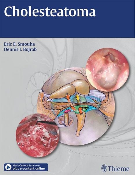 Produktbild: Cholesteatoma