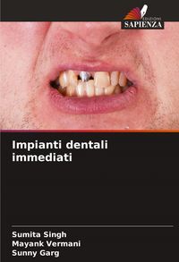 Produktbild: Impianti dentali immediati
