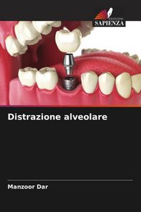 Produktbild: Distrazione alveolare