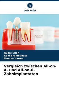 Produktbild: Vergleich zwischen All-on-4- und All-on-6-Zahnimplantaten