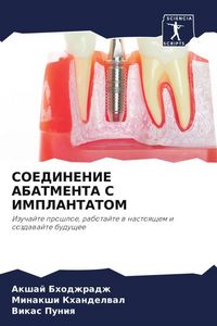 Produktbild: Soedinenie Abatmenta S Implantatom