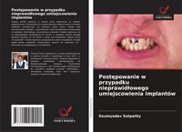 Produktbild: Post&iquest;powanie w przypadku nieprawid&iquest;owego umiejscowienia implant&oacute;w