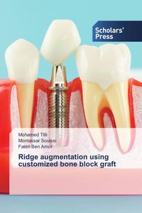 Produktbild: Ridge augmentation using customized bone block graft