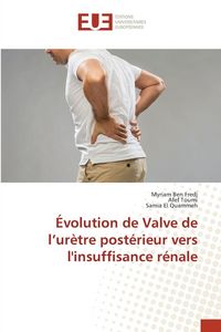 Produktbild: &Eacute;volution de Valve de l'ur&egrave;tre post&eacute;rieur vers l'insuffisance r&eacute;nale