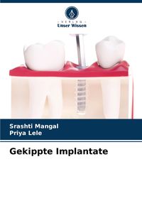 Produktbild: Gekippte Implantate
