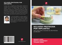 Produktbild: OCLUS&Atilde;O PROTEGIDA POR IMPLANTES