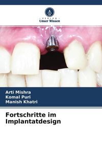 Produktbild: Fortschritte im Implantatdesign