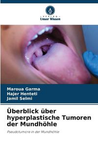 Produktbild: &Uuml;berblick &uuml;ber hyperplastische Tumoren der Mundh&ouml;hle