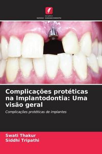 Produktbild: Complica&ccedil;&otilde;es prot&eacute;ticas na Implantodontia: Uma vis&atilde;o geral