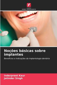 Produktbild: No&ccedil;&otilde;es b&aacute;sicas sobre implantes