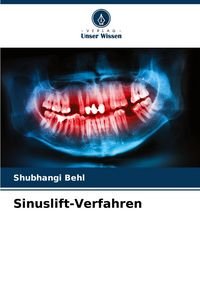 Produktbild: Sinuslift-Verfahren