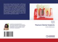 Produktbild: Titanium Dental Implants