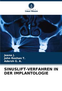 Produktbild: Sinuslift-Verfahren in der Implantologie