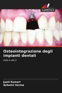 Produktbild: Osteointegrazione degli impianti dentali