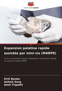 Produktbild: Expansion palatine rapide assist&eacute;e par mini-vis (MARPE)
