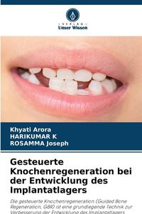 Produktbild: Gesteuerte Knochenregeneration bei der Entwicklung des Implantatlagers
