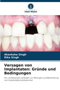 Produktbild: Versagen von Implantaten: Gr&uuml;nde und Bedingungen