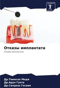Produktbild: Otkazy implantata