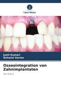Produktbild: Osseointegration von Zahnimplantaten