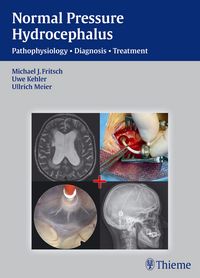 Produktbild: NPH - Normal Pressure Hydrocephalus