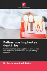 Produktbild: Falhas nos implantes dent&aacute;rios