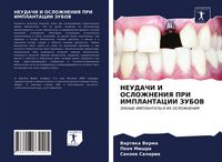 Produktbild: Neudachi I Oslozhneniya Pri Implantacii Zubov