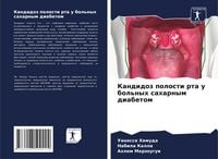 Produktbild: Kandidoz polosti rta u bol'nyh saharnym diabetom