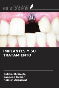 Produktbild: Implantes Y Su Tratamiento
