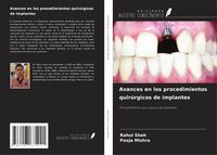 Produktbild: Avances en los procedimientos quir&uacute;rgicos de implantes