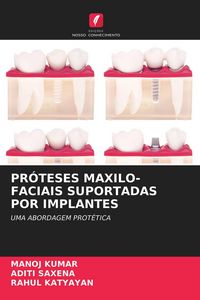 Produktbild: Pr&oacute;teses Maxilo-Faciais Suportadas Por Implantes