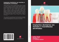 Produktbild: Implantes dent&aacute;rios em maxilas e mand&iacute;bulas atrofiadas